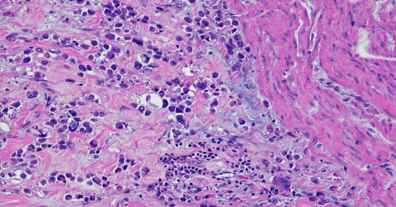 Plasmacytoid carcinoma of the urinary bladder