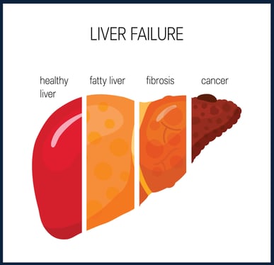 Liver Failure Diagram