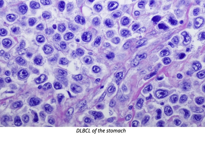 Diffuse Large B-Cell Lymphoma (DLBCL) of Stomach