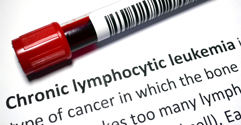 chronic lymphocytic leukemia - blood sample
