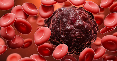 Microscopic view of acute myeloid leukemia (AML) cells surrounded by blood cells in a blood vessel