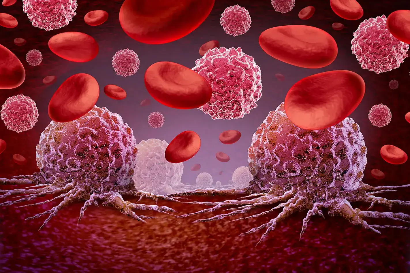 Acute Myeloid Leukemia Cells in the blood stream.