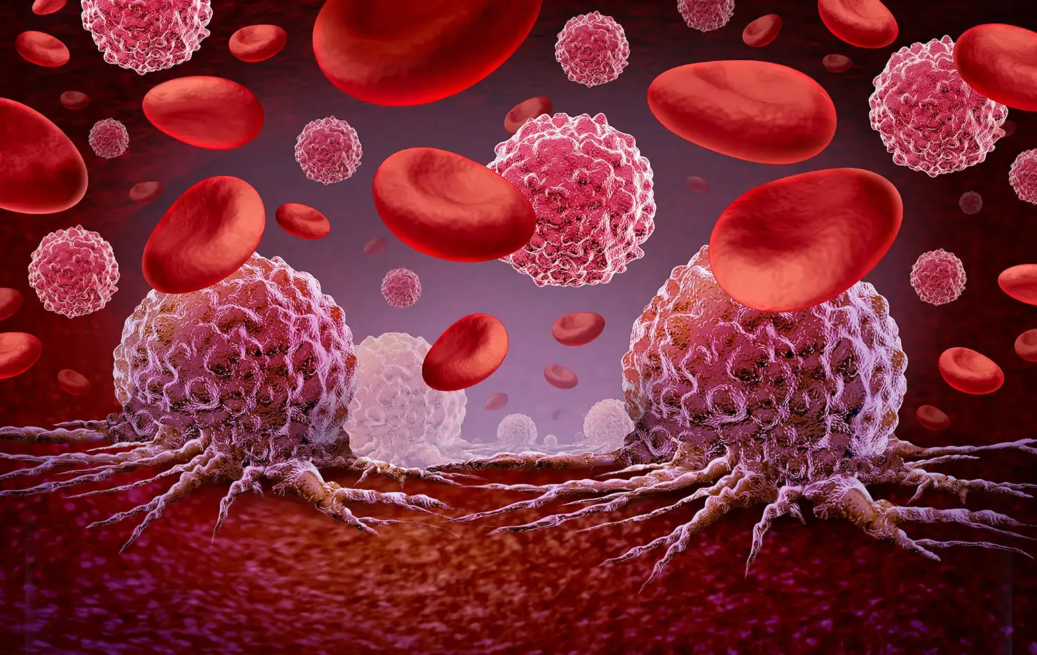 Acute Myeloid Leukemia Cells in the blood stream.