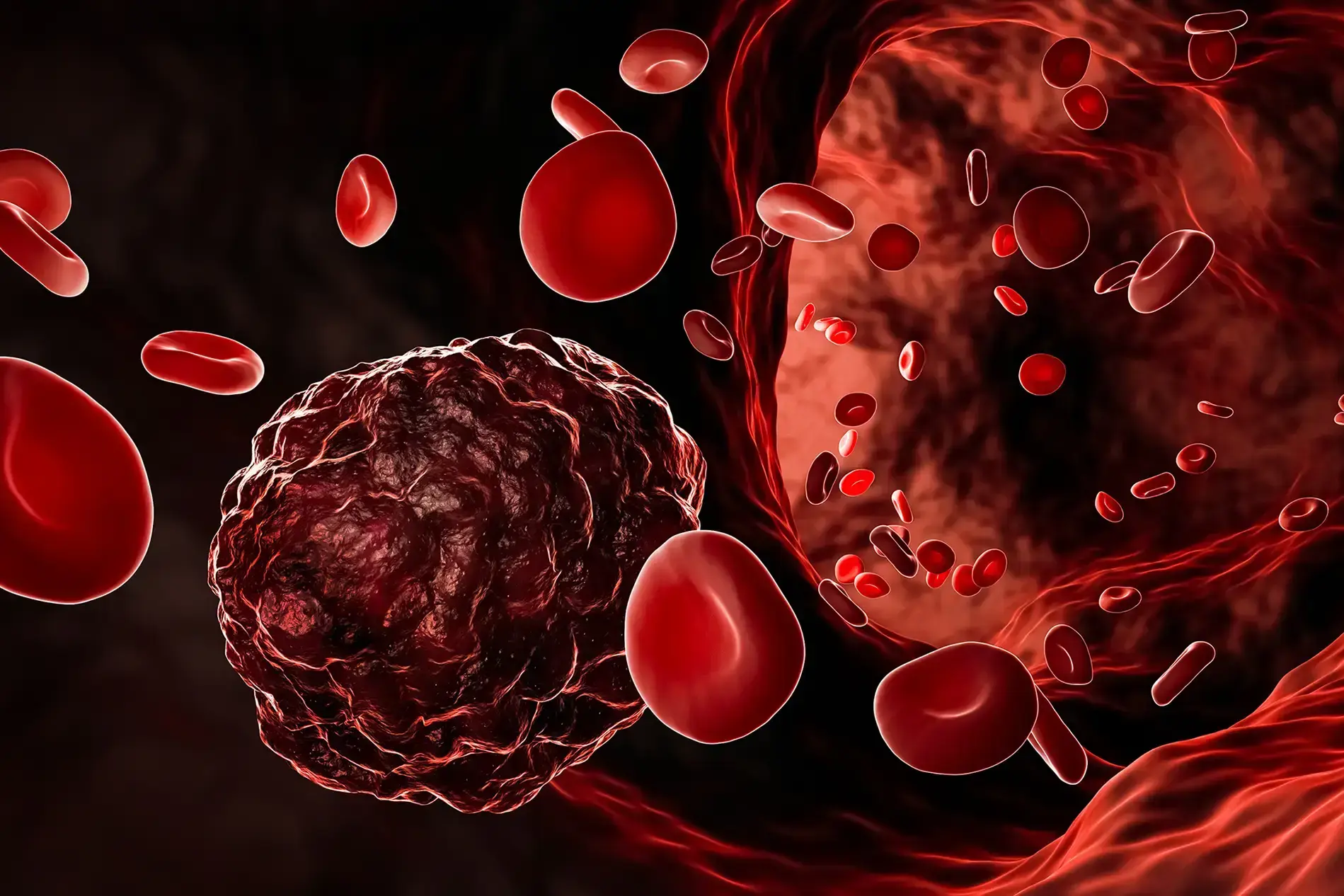 Primary blood cancer cells surrounded by red blood cells in the blood flow.