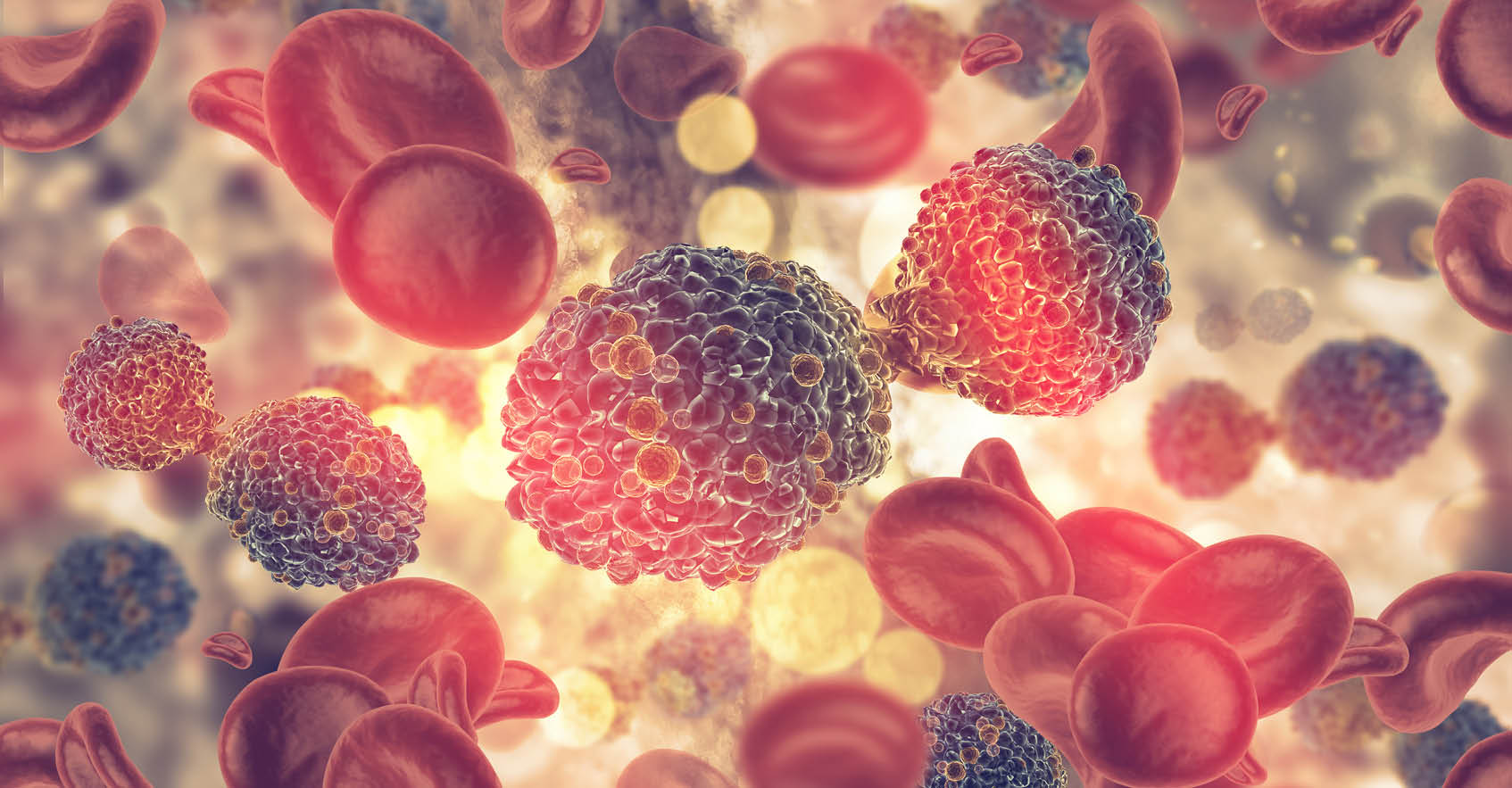 Microscopic view of Multiple Myeloma (MM) cells surrounding healthy red blood cells (RBCs) that are circulating in a blood vessel.
