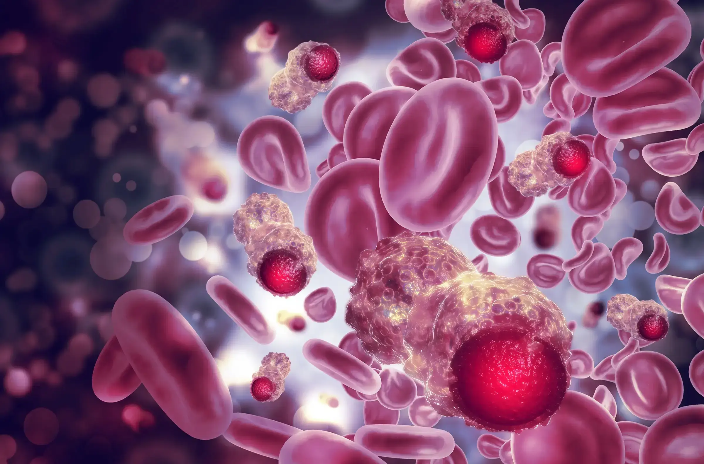 Multiple Myeloma cells in the blood stream together with red blood cells.