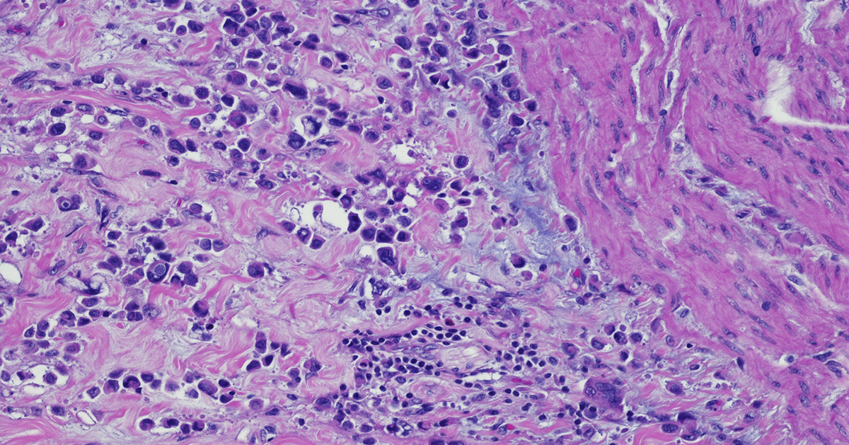 Plasmacytoid carcinoma of the urinary bladder